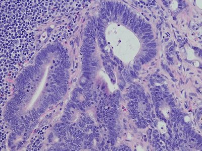 FDA Approves Sotorasib + Panitumumab for mCRC